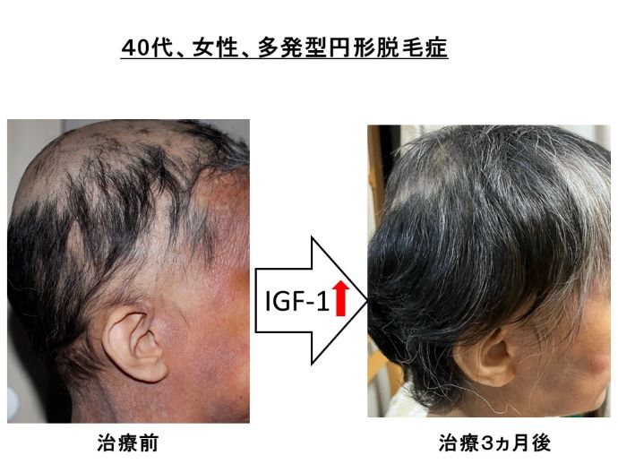 円形脱毛症　病院